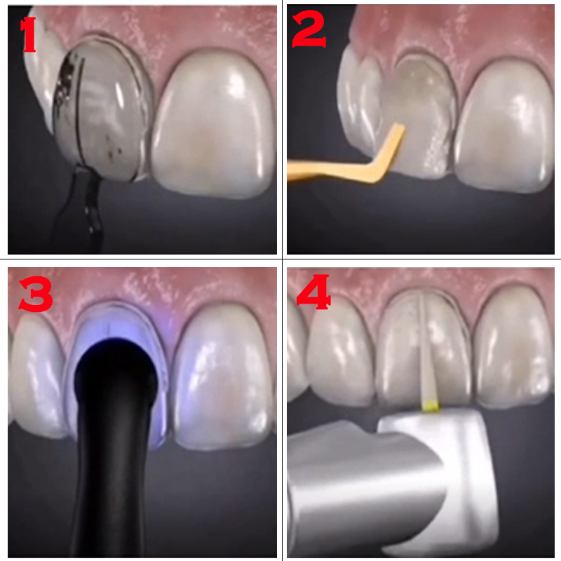 Autoclavable Dental Veneer Mou - Teeth Whitening Moulds review and price